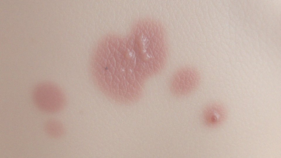 Jakie są różnice między bliznami a przebarwieniami po ospie?